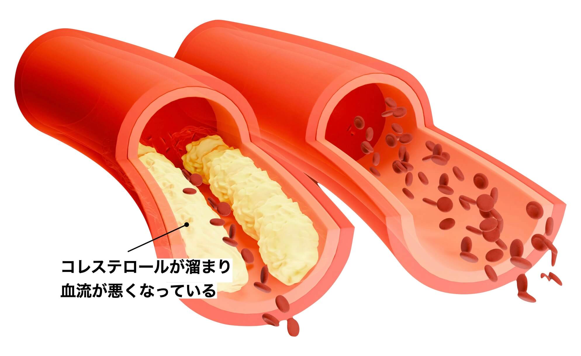 体内にコレステロールが溜まったらどうなるかの説明の図